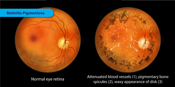 Millions Affected, No Cure